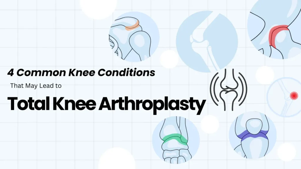 4 Common Knee Conditions That May Lead to Total Knee Arthroplasty