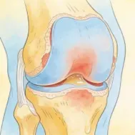 inflammatory arthritis