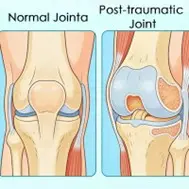 post-traumatic arthritis
